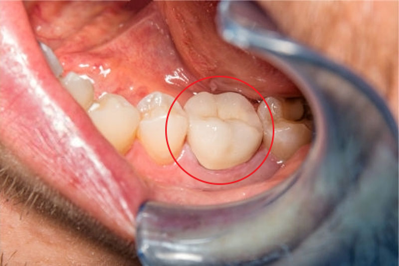 Bọc răng sứ cho răng hàm giúp bảo vệ răng tốt hơn
