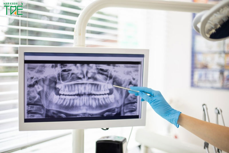 Chụp X-quang răng có ảnh hưởng gì không?