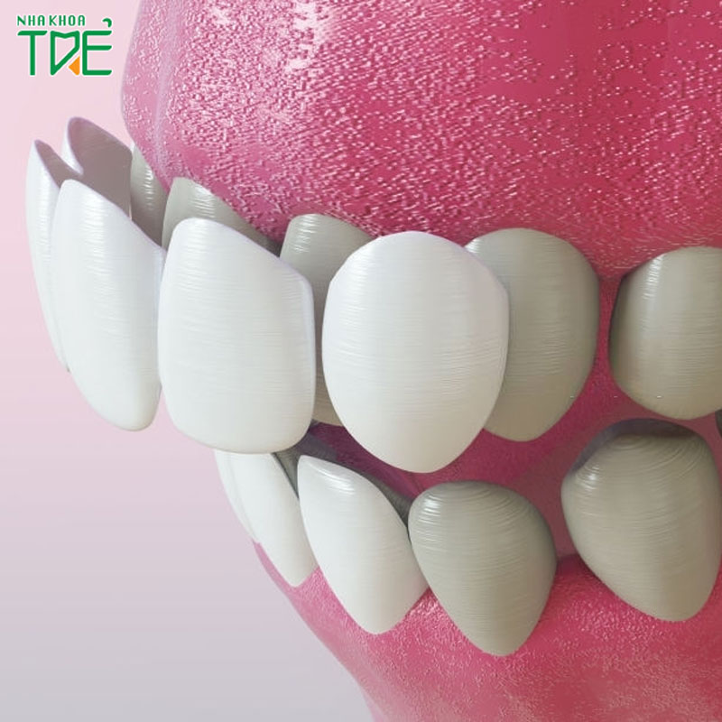 Dán răng sứ có phải mài răng không?