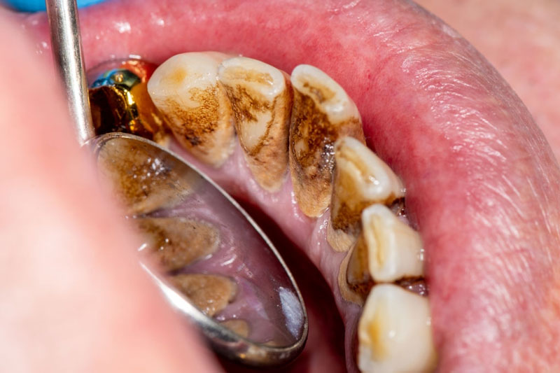 Mảng bám cao răng quá dày và cứng có thể gây đau nhức nhẹ sau khi loại bỏ