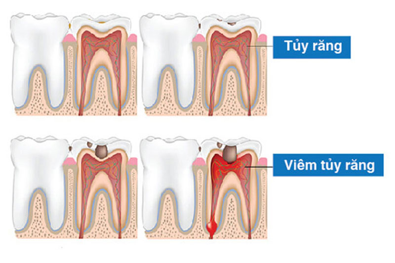 Răng viêm tủy cần được điều trị