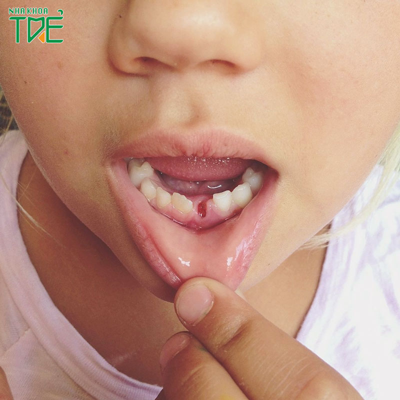 Nhổ răng cho bé đúng thời điểm để răng vĩnh viễn mọc đều đẹp