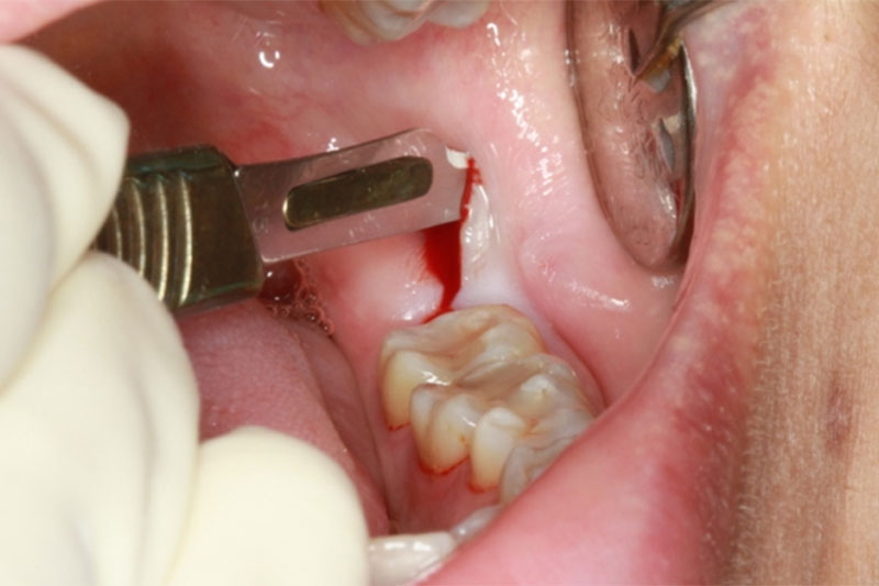 Nhổ răng khôn làm đau răng số 7 có thể do tay nghề bác sĩ thực hiện