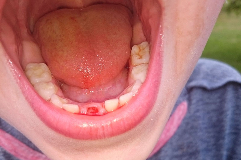 Chiếc răng sữa đầu tiên được thay thế là răng cửa hàm dưới