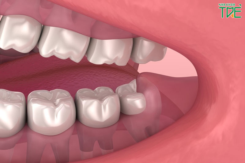 Răng khôn có nên nhổ không? Khi nào thì bắt buộc phải nhổ răng khôn?