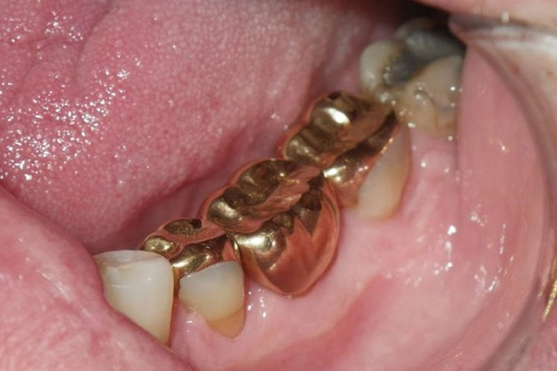 Răng sứ kim loại có thể làm bằng vàng