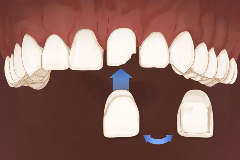 Dán răng sứ và bọc răng sứ đều đảm bảo độ bền chắc cao
