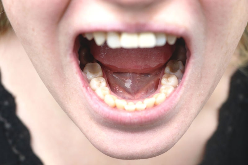 Sâu răng hình thành lỗ rỗng trên mặt ăn nhai của răng