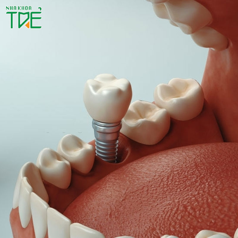 Sau nhổ răng thực hiện cấy ghép Implant tức thì như thế nào?