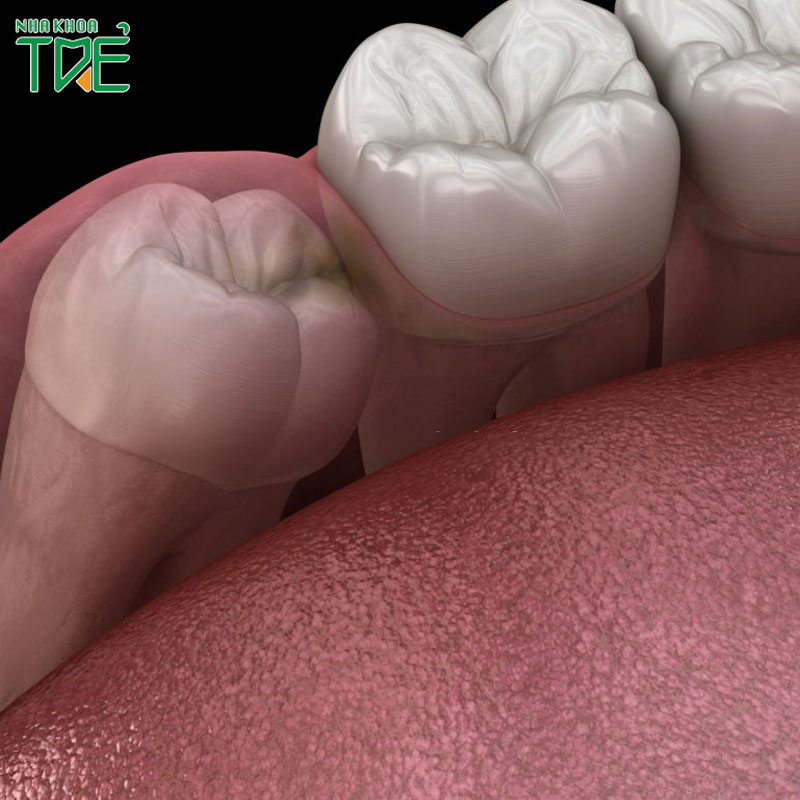 Viêm lợi trùm răng khôn uống thuốc gì để giảm đau, giảm sưng?