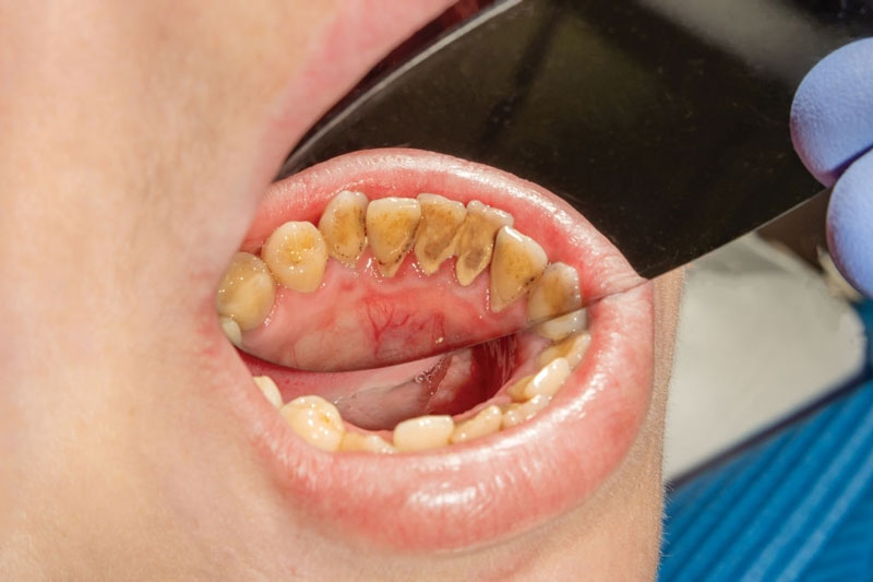 Mảng bám cao răng gây ra bệnh viêm lợi