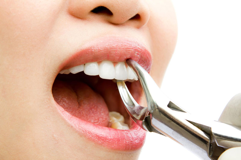 Răng viêm tủy nặng có thể phải nhổ răng
