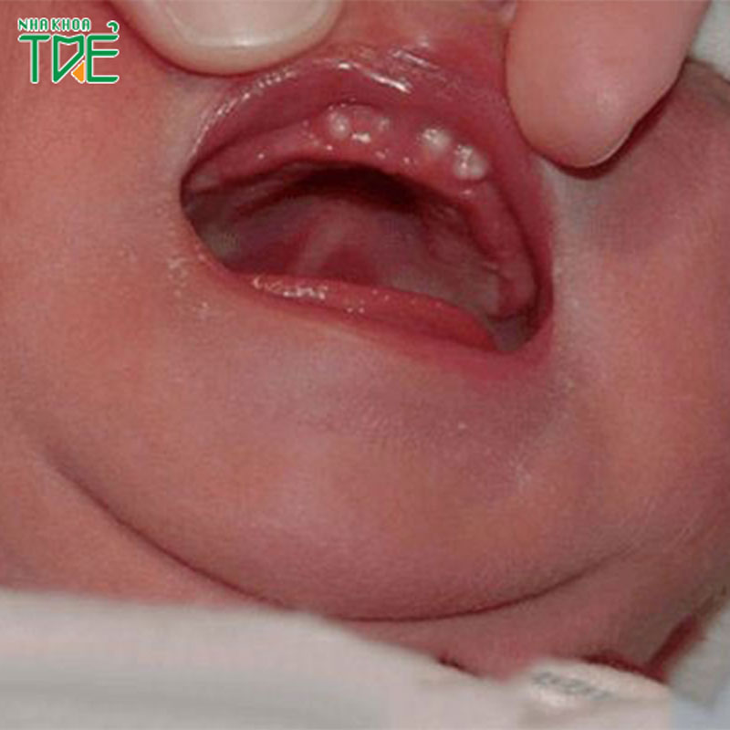 Nanh sữa ở trẻ sơ sinh: Dấu hiệu nhận biết và cách xử lý
