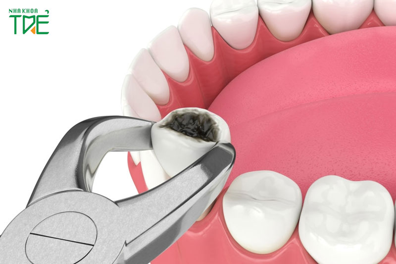 Nhổ răng hàm dưới có nguy hiểm không?