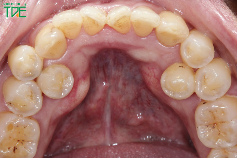 Nhổ răng mọc dư thừa có nguy hiểm không?