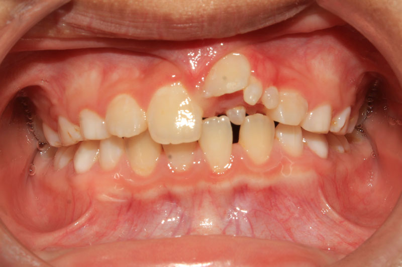 Răng mọc dư gây mất thẩm mỹ và ảnh hưởng đến ăn nhai