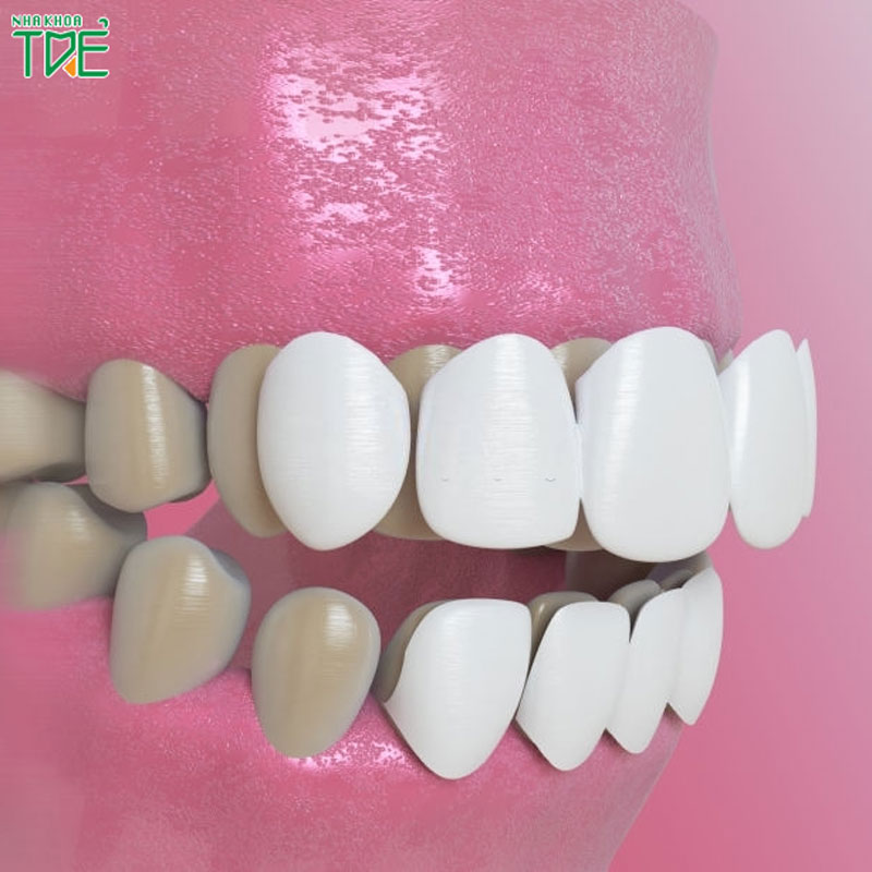 Quy trình dán răng sứ Veneer chuẩn quốc tế diễn ra như thế nào?