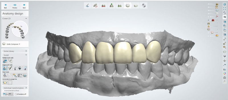 Thiết kế răng giả tháo lắp với phần mềm hiện đại đảm bảo độ chính xác cao