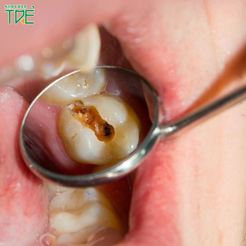 Răng sâu vào tủy: Mối nguy hại cho sức khỏe răng miệng