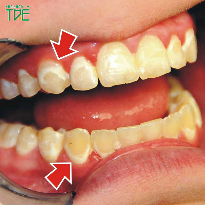 Răng trẻ em có đốm trắng là bệnh gì?