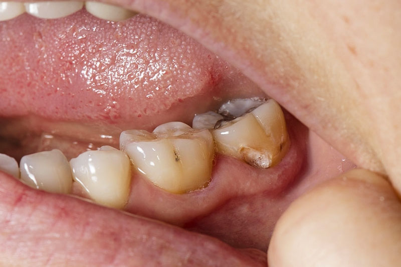 Sâu răng, viêm tủy làm nướu lợi bị sưng 
