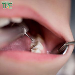 Trám răng cho trẻ 4 – 5 tuổi bị sâu có được không?