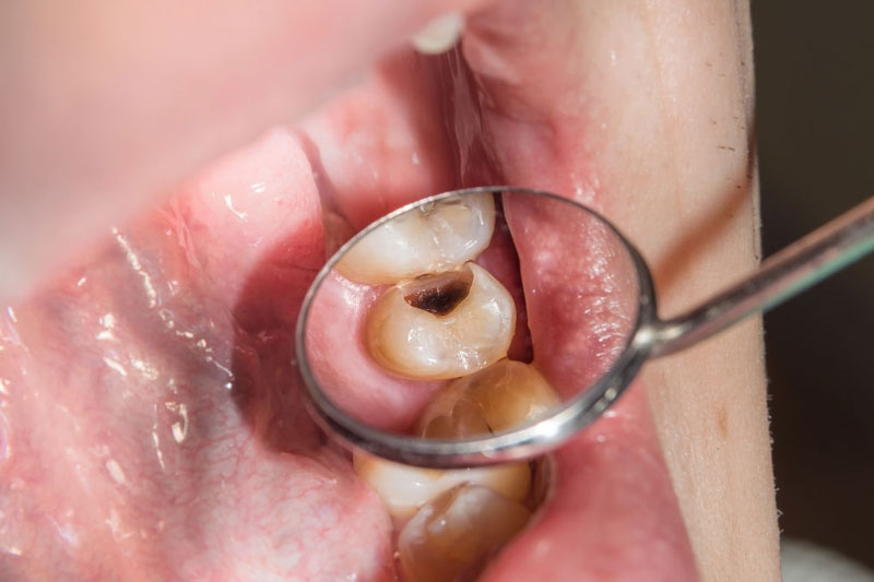 Răng vỡ vào tủy răng cần tiến thành điều trị tủy trước khi tám răng