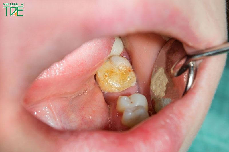 Trẻ 3 tuổi sâu răng hàm có nên hàn răng không?