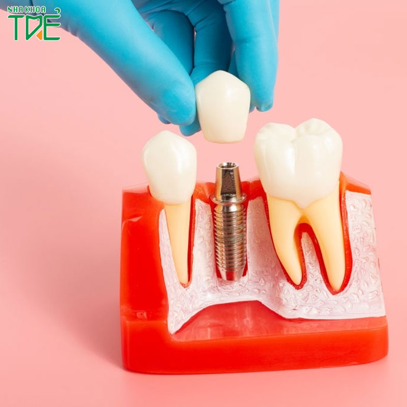 Trồng răng Implant Hàn Quốc có tốt không?