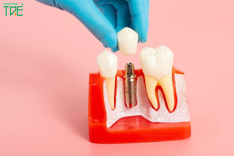 Trồng răng Implant Hàn Quốc có tốt không?