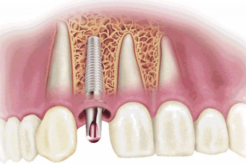 Cấy ghép trụ Implant trong xương hàm thay thế chân răng 