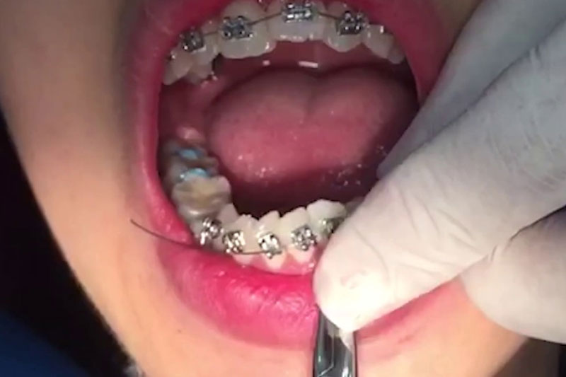Đứt dây cung khi niềng răng có thể làm tổn thường mô mềm trong khoang miệng
