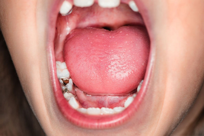 Sâu răng khiến trẻ đau răng sưng má