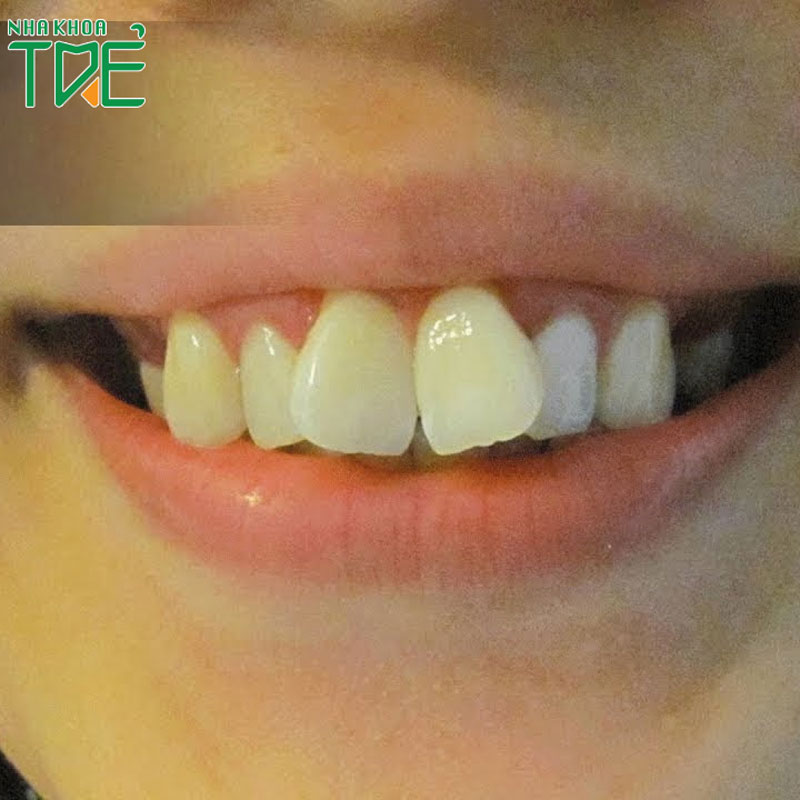 2 răng cửa hô và to nên niềng răng hay bọc răng sứ?