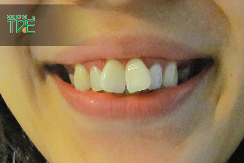 2 răng cửa hô và to nên niềng răng hay bọc răng sứ?