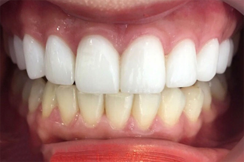 Bọc răng sứ cao răng mang lại hàm răng thẳng hàng, trắng sáng
