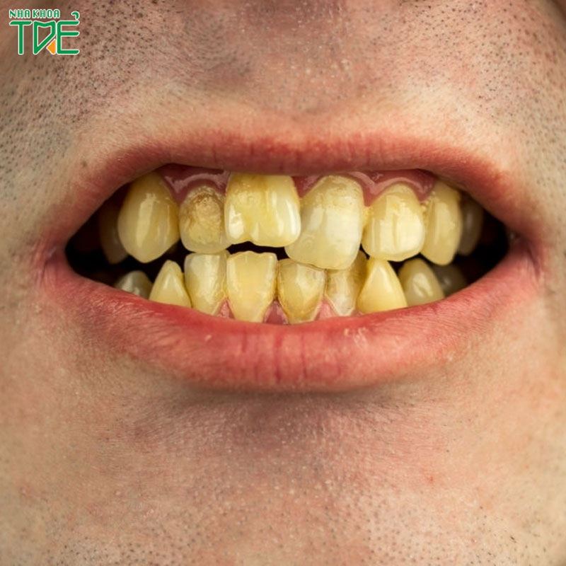 7 cách chữa răng ố vàng thành trắng sáng đơn giản, hiệu quả không ngờ
