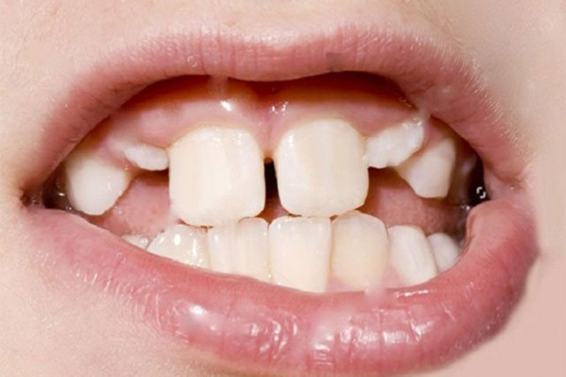 Răng cửa quá to có thể dẫn đến mọc răng khểnh ở trẻ