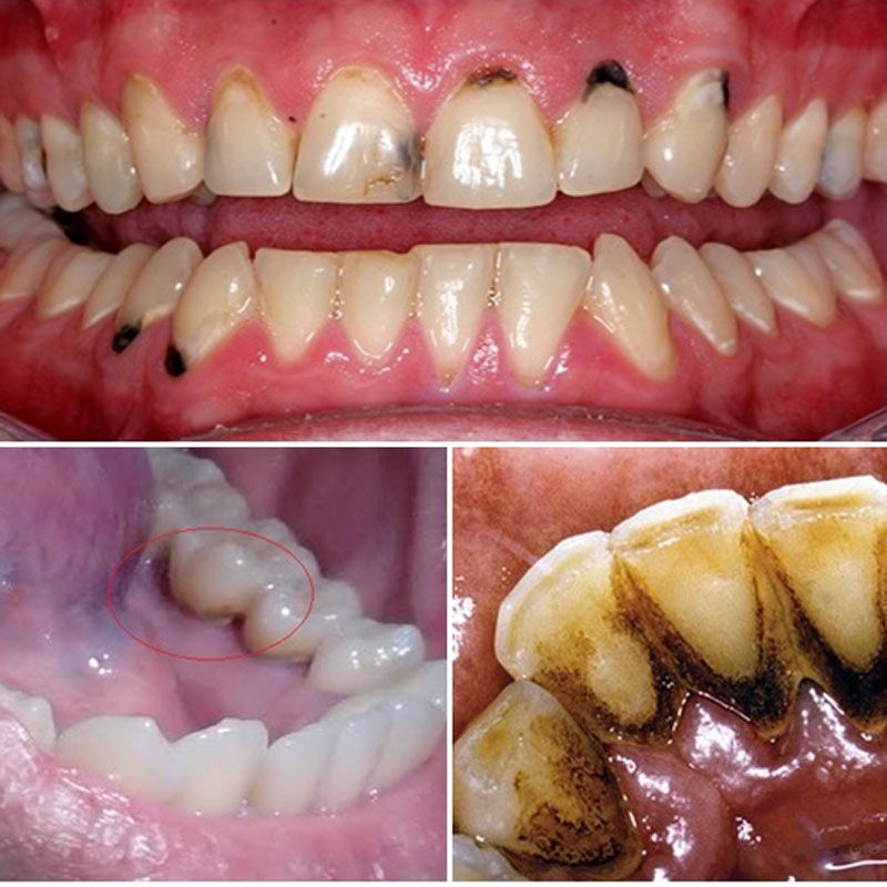 Tại sao chân răng có màu đen? Cách khắc phục như thế nào?