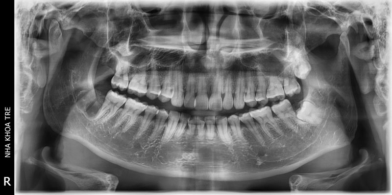 Chụp X-quang răng nhằm đánh giá mức độ nặng nhẹ của bệnh lý răng miệng