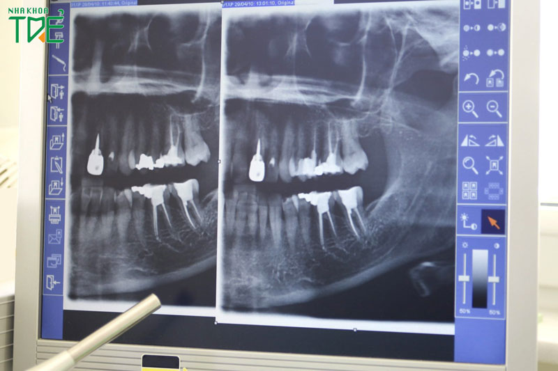 Chụp x-quang răng trong nha khoa