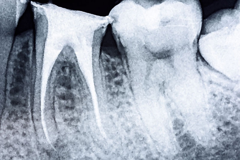 Chụp X-quang cánh cắn để xác định tình trạng tủy răng
