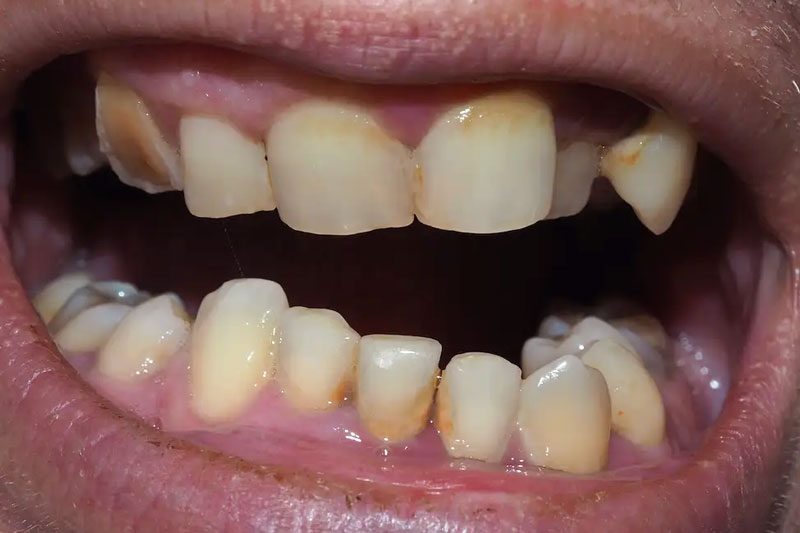Răng khểnh làm tăng nguy cơ mắc bệnh lý răng miệng