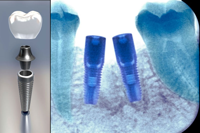 Trồng răng sứ Implant phục hình răng từ chân răng
