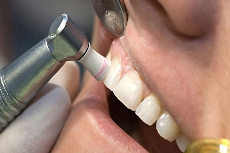 Đánh bóng răng - kết thúc quá trình lấy cao răng