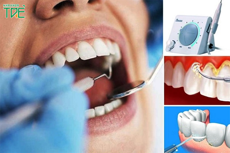 Lấy cao răng không đau với công nghệ siêu âm hiện đại