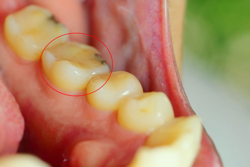 Vật liệu trám cần thời gian để ổn định trên bề mặt răng