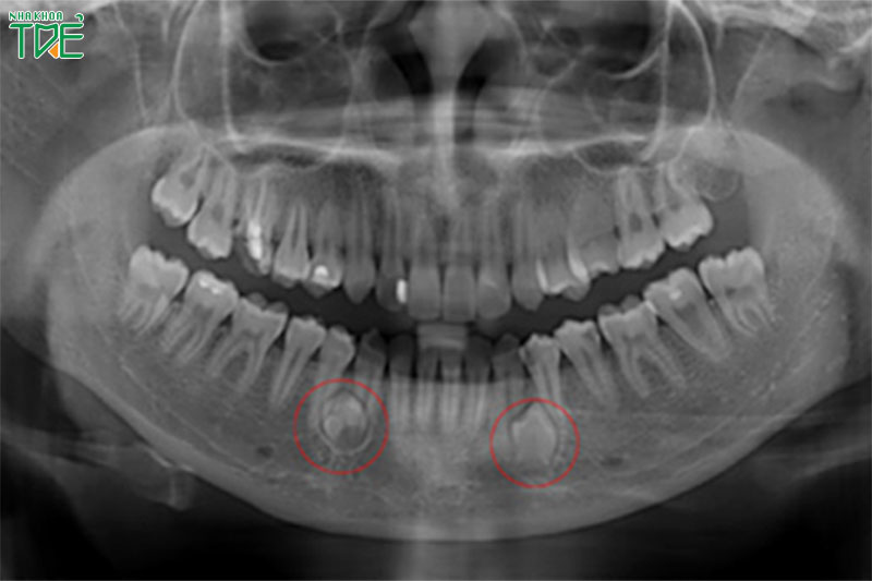 Nang chân răng là gì? Dấu hiệu nhận biết và cách điều trị