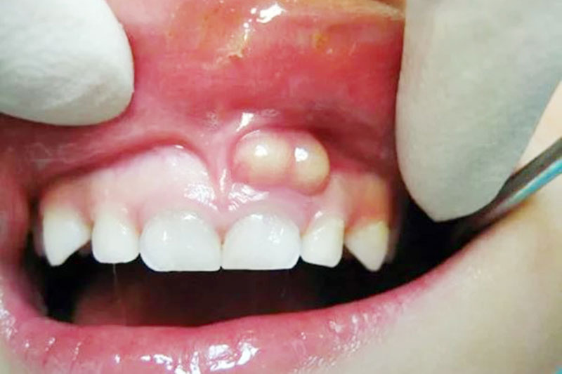 Nang chân răng nặng có hiện tượng sưng phồng, đau nhức