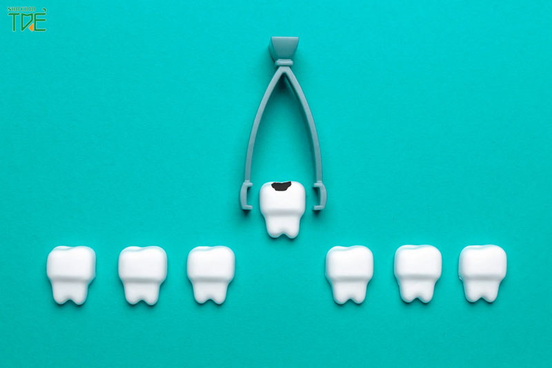 Nhổ răng cửa cần lưu ý những gì? Giá nhổ răng cửa là bao nhiêu?